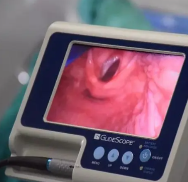 xy-204-b-087麻醉视频喉镜
