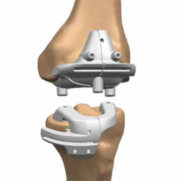 通用型增材制造膝关节手术导板