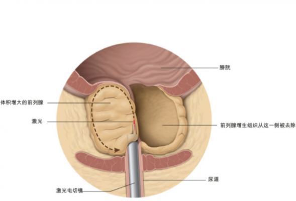 经尿道植入前列腺束钉ul400-4