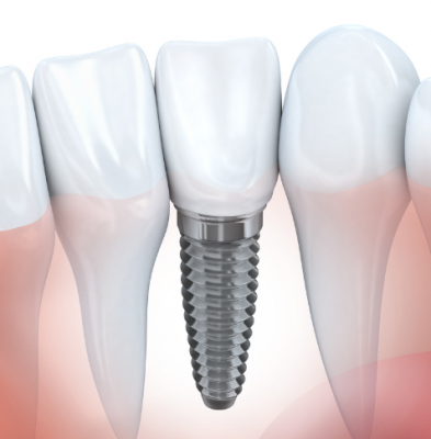 牙种植体dental implants