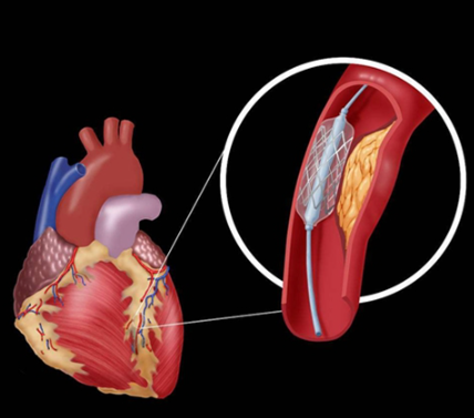 一次性使用冠状动脉介入手术控制系统附件