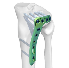 足部锁定接骨板系统fracture and correction system