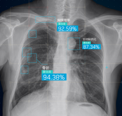 胸部骨折ct图像辅助分诊软件inferread ct fracture