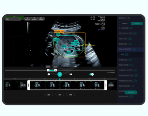 产前动态超声影像处理系统airiscan q6