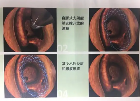 全降解鼻窦药物支架系统sdes4212-1浦易