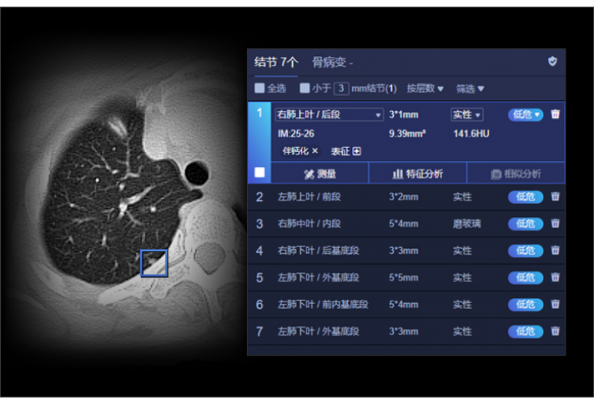 肺结节ct图像辅助检测软件uai-pioneerchest联影