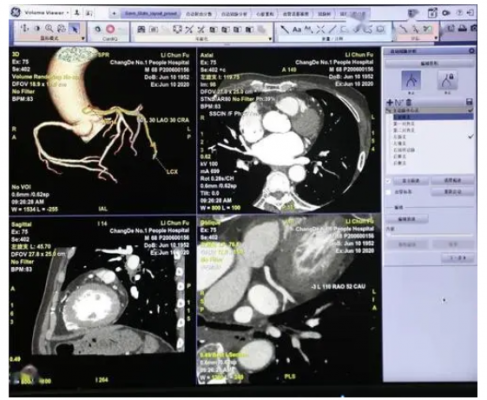 冠脉ct造影图像血管狭窄辅助评估软件inferread cta coronary