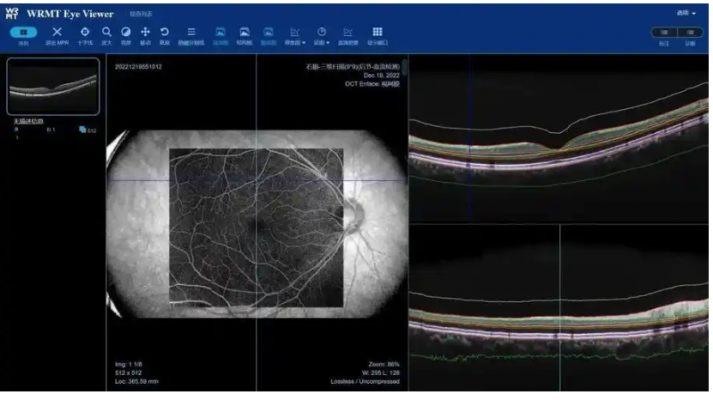 眼底病变眼底图像辅助诊断软件mcs（云服务器版）