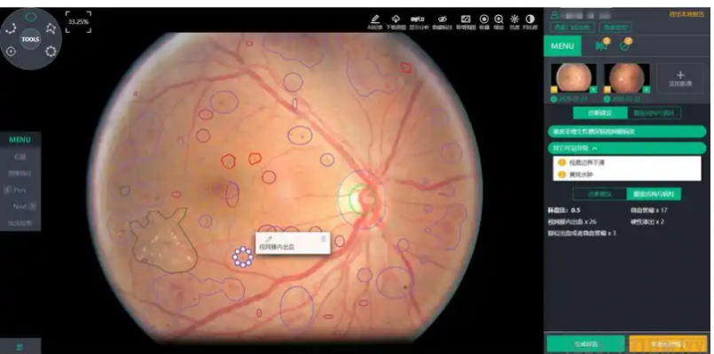 眼底病变眼底图像辅助诊断软件ai-100康夫子