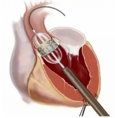 经导管主动脉瓣系统fg17000-av23