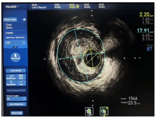 血管内超声影像处理软件into ivus