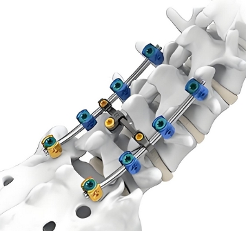  脊柱内固定系统组件