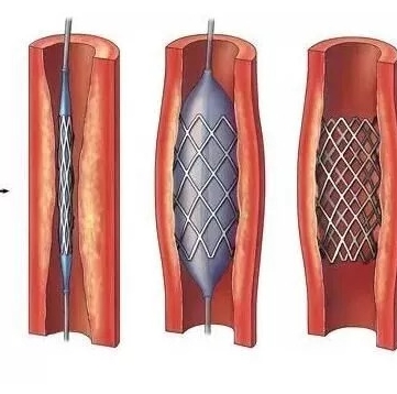  药物洗脱冠脉支架系统